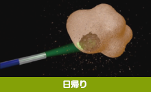 結石を見ながら粉砕・摘出 尿管結石内視鏡手術(TUL)